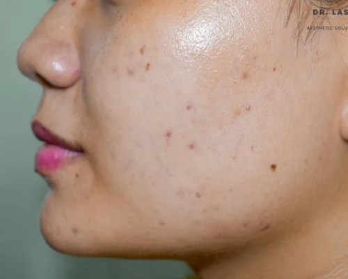 Say Goodbye to Dark Spots_ How Our Clinic Treats Hyperpigmentation Safely - Image 01